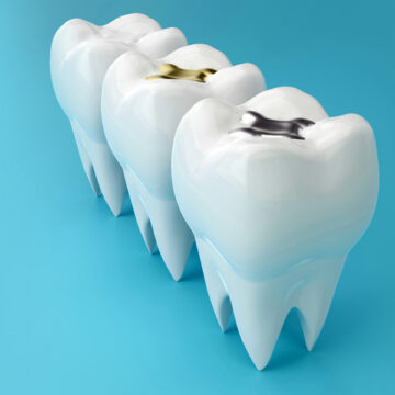 Can Dental Fillings Fall Out? What Should I Do if That Happens?