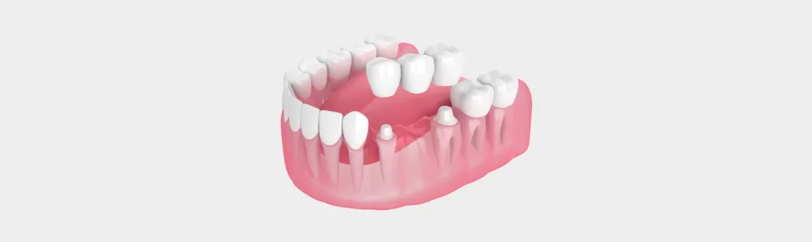 Are Dental Bridges Necessary for Chewing and Speaking Properly?