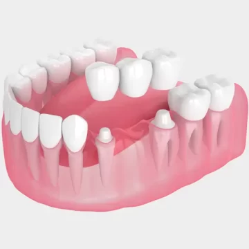 Are Dental Bridges Necessary for Chewing and Speaking Properly?